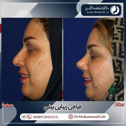 جراحی-زیبایی-بینی-590