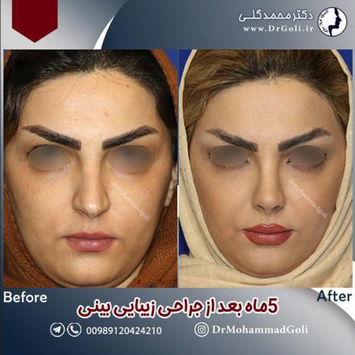 جراحی-زیبایی-بینی-592