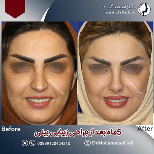 جراحی-زیبایی-بینی-593