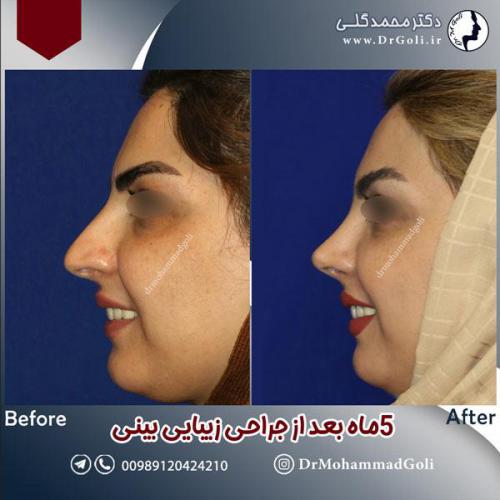 جراحی-زیبایی-بینی-595