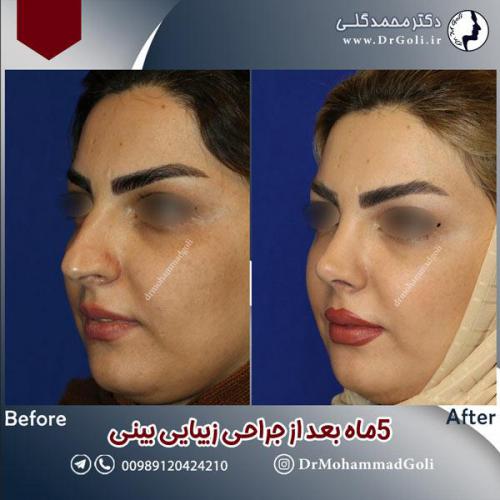 جراحی-زیبایی-بینی-596