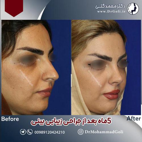 جراحی-زیبایی-بینی-598