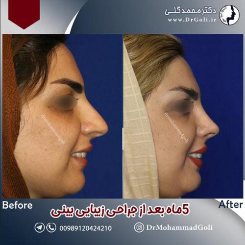 جراحی-زیبایی-بینی-599
