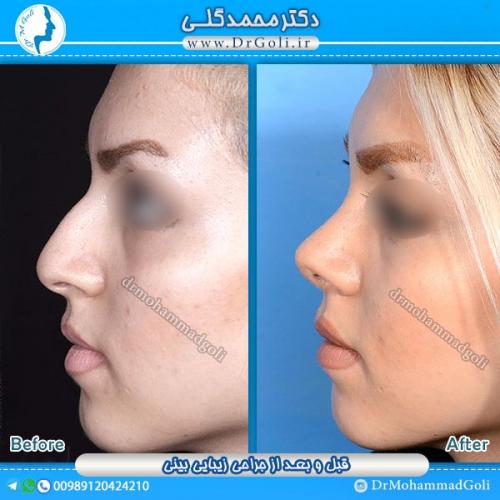 جراحی-زیبایی-بینی-6