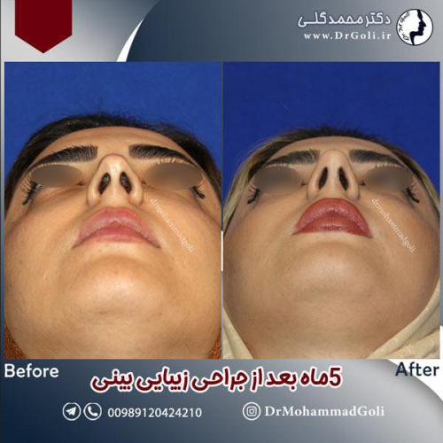 جراحی-زیبایی-بینی-600