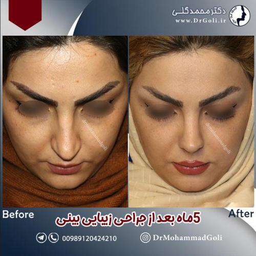 جراحی-زیبایی-بینی-601