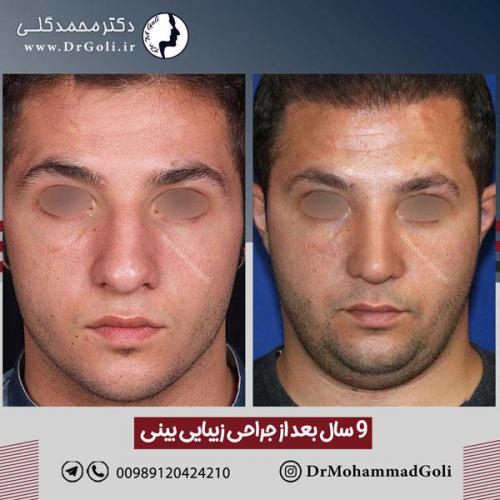جراحی-زیبایی-بینی-602