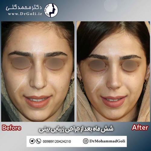 جراحی-زیبایی-بینی-611