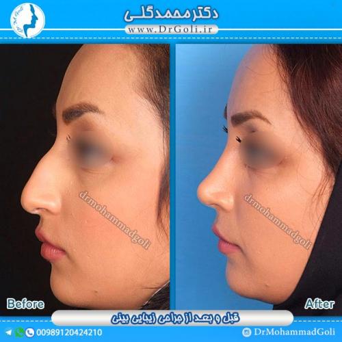 جراحی-زیبایی-بینی-7