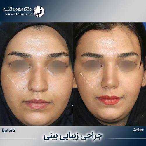 جراحی-زیبایی-بینی-747