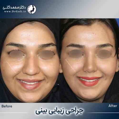 جراحی-زیبایی-بینی-748