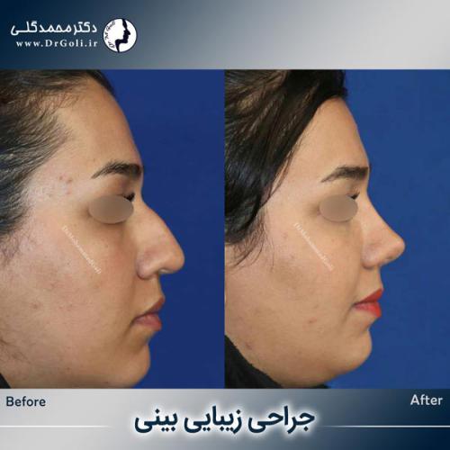 جراحی-زیبایی-بینی-750