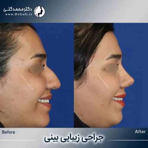 جراحی-زیبایی-بینی-751