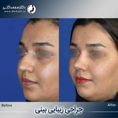 جراحی-زیبایی-بینی-752