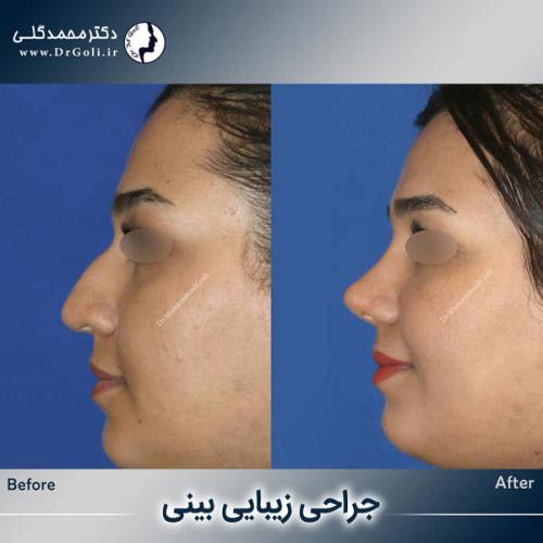 جراحی-زیبایی-بینی-754