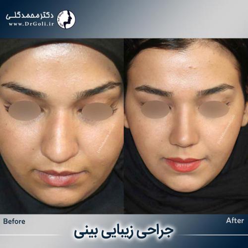جراحی-زیبایی-بینی-755