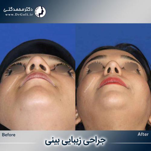 جراحی-زیبایی-بینی-756