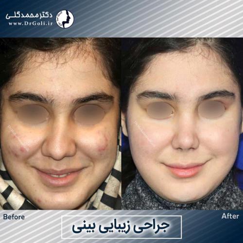 جراحی-زیبایی-بینی-757