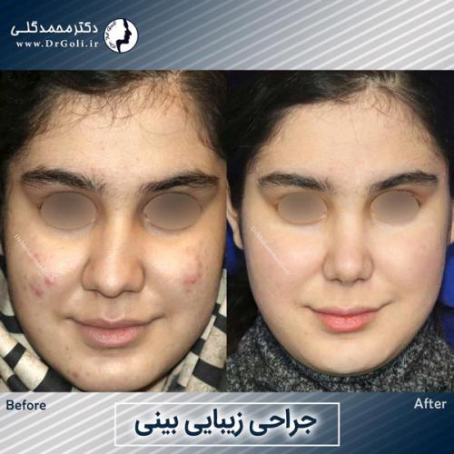 جراحی-زیبایی-بینی-758