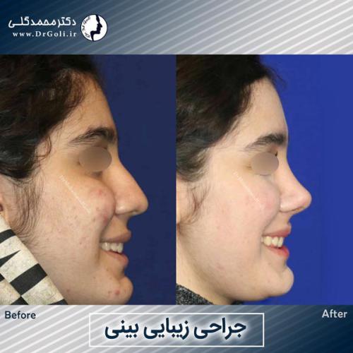 جراحی-زیبایی-بینی-763