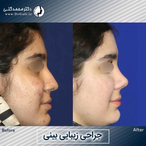 جراحی-زیبایی-بینی-764