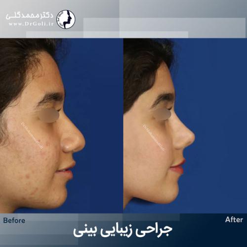 جراحی-زیبایی-بینی-770
