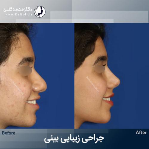 جراحی-زیبایی-بینی-771