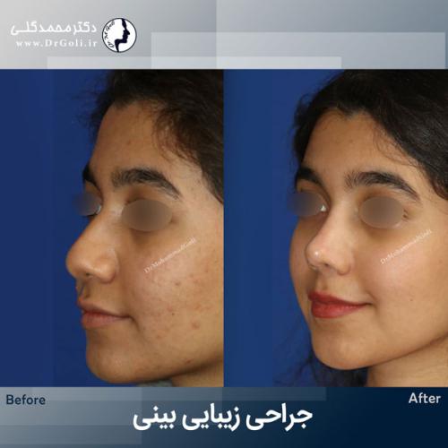 جراحی-زیبایی-بینی-772