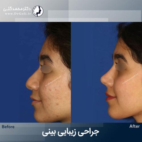 جراحی-زیبایی-بینی-774