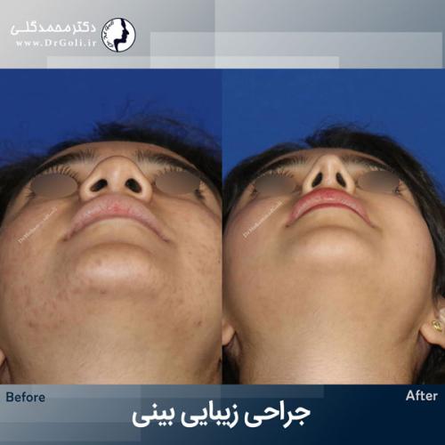 جراحی-زیبایی-بینی-775