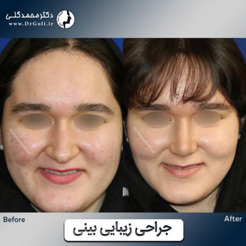 جراحی-زیبایی-بینی-777