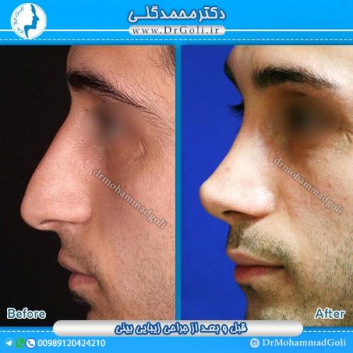 جراحی-زیبایی-بینی-8