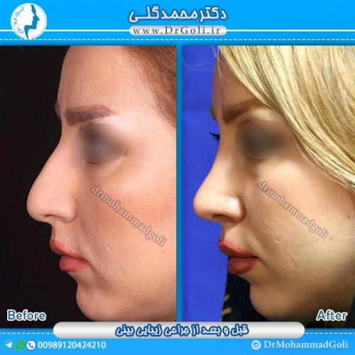 جراحی-زیبایی-بینی-9