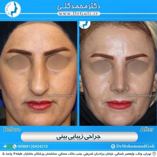 جراحی زیبایی بینی 105