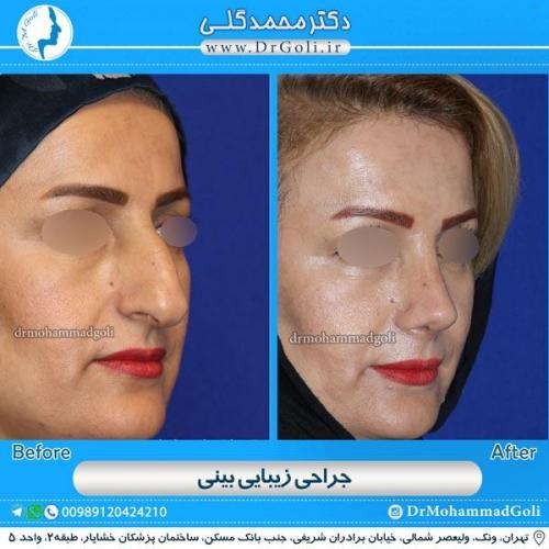 جراحی زیبایی بینی 106