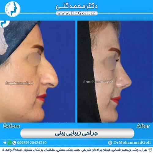 جراحی زیبایی بینی 107