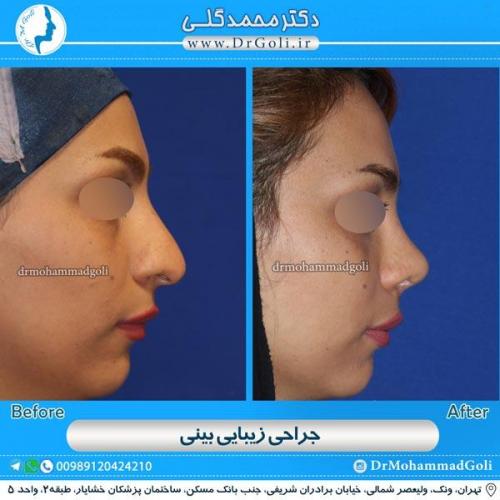 جراحی زیبایی بینی 108