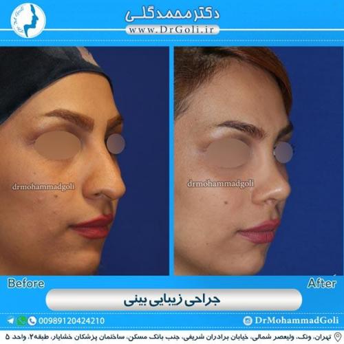 جراحی زیبایی بینی 109