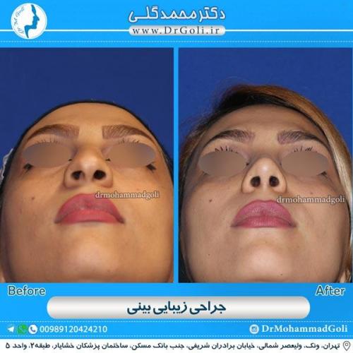 جراحی زیبایی بینی 110