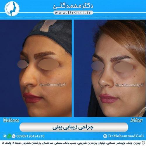 جراحی زیبایی بینی 112