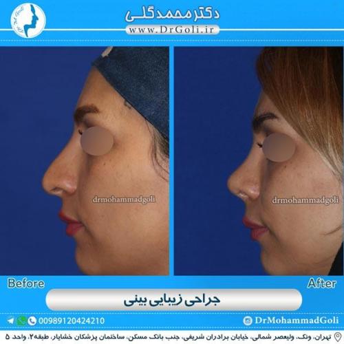 جراحی زیبایی بینی 113