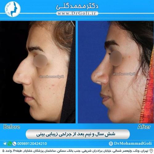 جراحی زیبایی بینی 122
