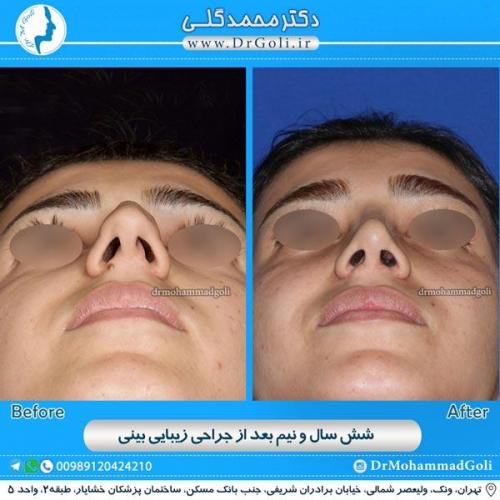 جراحی زیبایی بینی 124