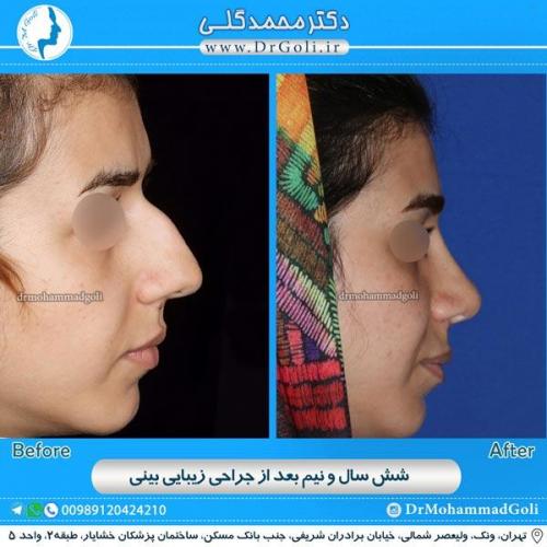 جراحی زیبایی بینی 125