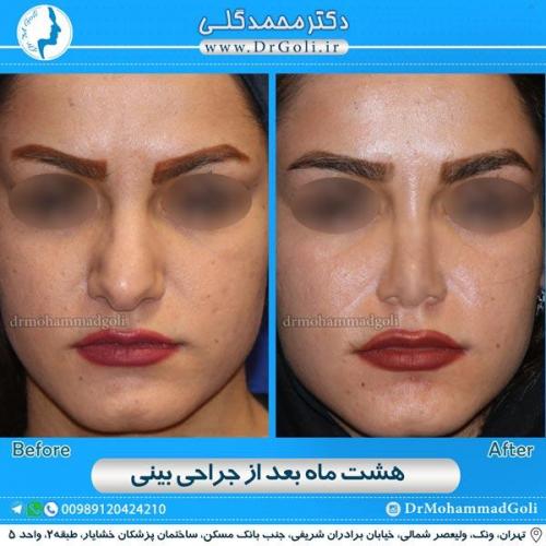 جراحی زیبایی بینی 126