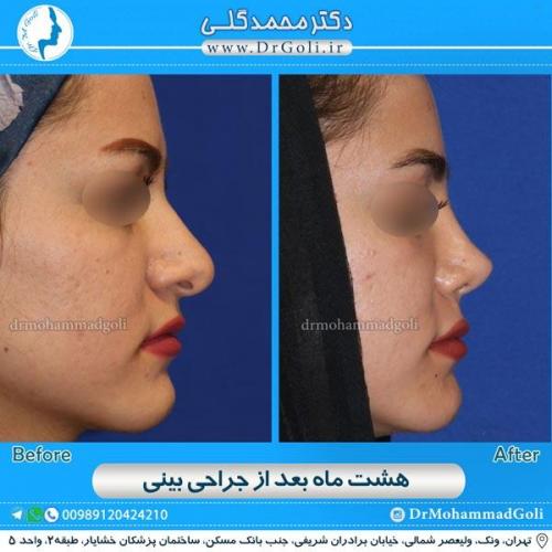جراحی زیبایی بینی 127