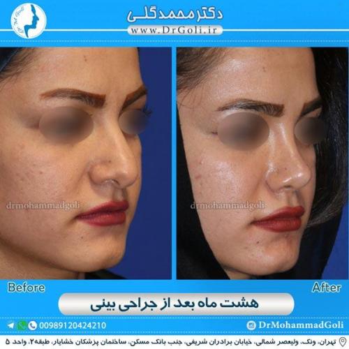 جراحی زیبایی بینی 128