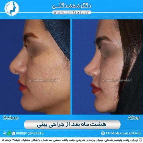 جراحی زیبایی بینی 129