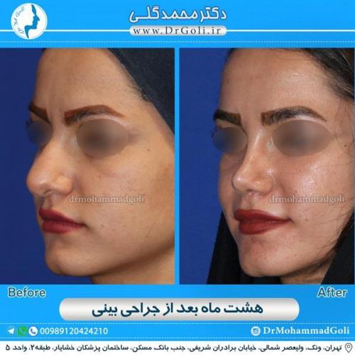 جراحی زیبایی بینی 130