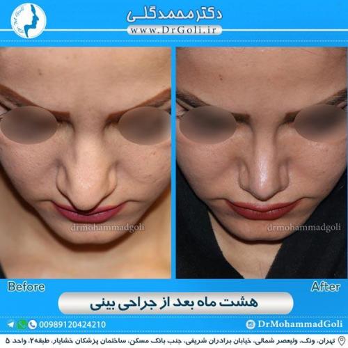 جراحی زیبایی بینی 131